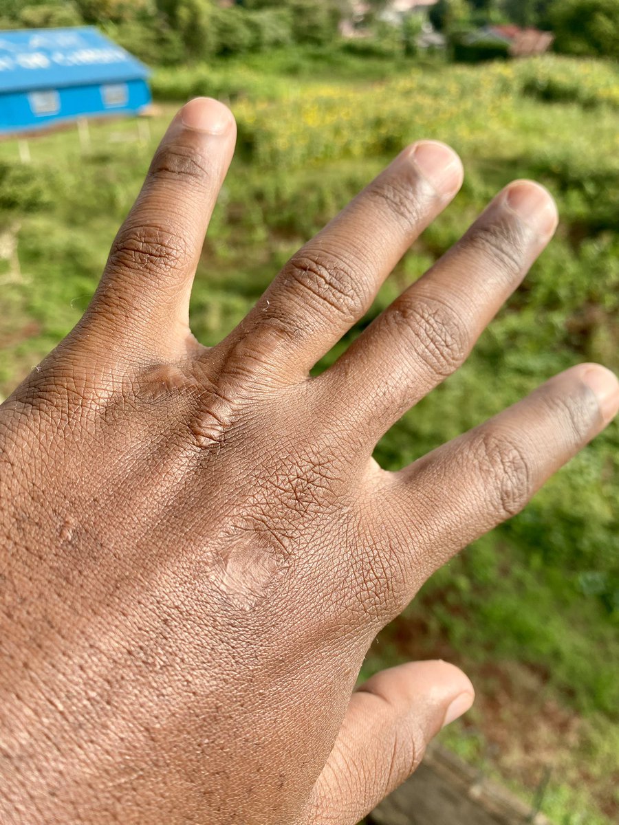 These are the burnt marks I’ve lived with on my left hand since I was 10 when my dad smeared kerosene & placed a matchstick flame as punishment for insinuating I’d stolen a Bill Cosby novel. He beat me to a pulp I had to lie so he could leave me alone coz I thought I would die.