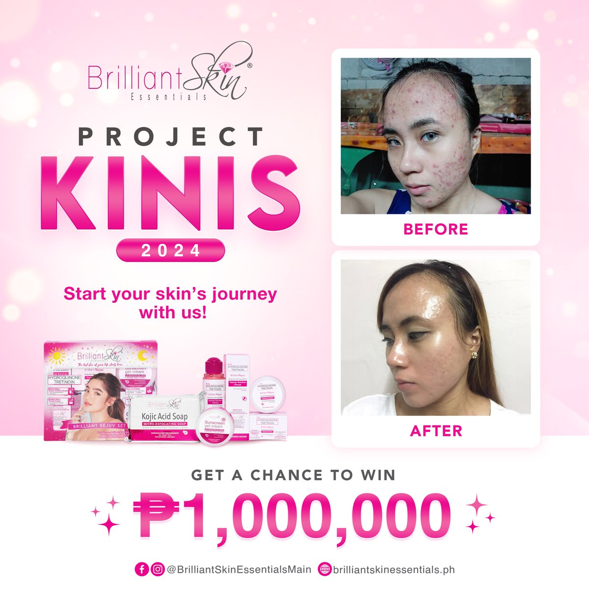 IamMissGlenda_'s tweet photo. Handa kana bang manalo ₱1,000,000.00? 🤩

I-comment ang inyong photo na karapat-dapat kayong makasaki sa aming #ProjectKinis2024! 💯

Sa lahat ng may mga ACNE, MELASMA or ANY FACIAL SKIN PROBLEMS, baka ikaw na ang hinahanap namin. ♥️

#PINAKAMAKINANG✨ https://t.co/IdgJl0B05z