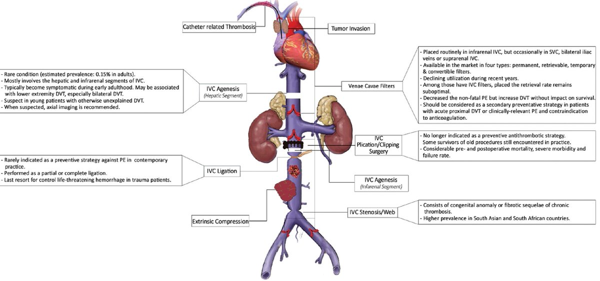 Interruption VCI  medvasc.info/archives-blog/… @YogenKanthi <a href="/YotisSenis/">Yotis Senis</a> <a href="/yara_rf/">yara fares</a> <a href="/GaetaneRibeyre/">Gaetane Ribeyre@vaccinée!!! 💉 X 3! + 🦠…</a> <a href="/mdrechsler/">Michèle Drechsler</a> <a href="/ESVM_/">European Society of Vascular Medicine</a> <a href="/AdrianZidaritz/">Adrian Zidaritz</a> <a href="/lasfmv/">SFMV</a> <a href="/SFPhlebo/">SF Phlébologie</a> @AngiologieCHUV