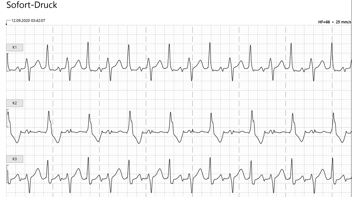 CPVT seen in a Holter strip!