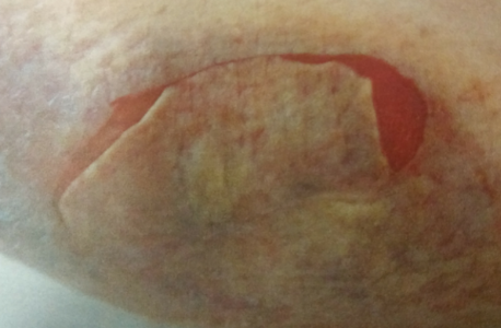 Understanding the type of skin tear is crucial for proper wound care management. What classification would you give this skin tear? Here is a link to the ISTAP classification system: images.skintghent.be/20181251211525… #WWIC #WoundHealing #skin