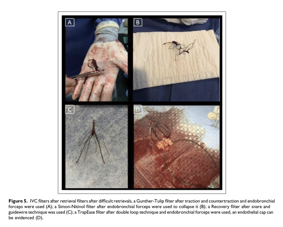 Inferior Vena Cava Filter Long Term Complications and Retrieval Techniques: A Case Series and Literature Review 
<a href="/UMVascular/">UMiami Vascular Surgery</a> <a href="/SageJournals/">Sage Journals</a> 
#Vascsurg #VenousEd 

journals.sagepub.com/doi/10.1177/15…
