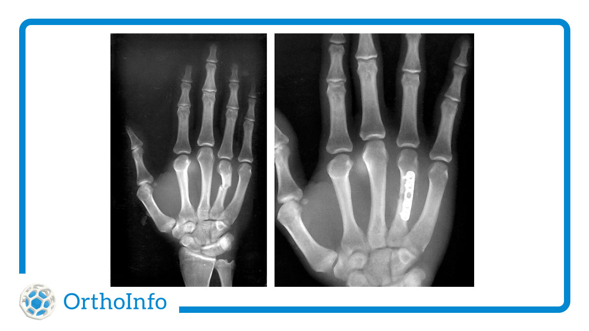 AAOS1's tweet image. Bad news for @warriors guard Chris Paul, whose #handfracture required surgical repair. In many cases, a hand fracture will heal well with nonsurgical treatment. Learn when surgery is necessary at #OrthoInfo: bit.ly/3KWt3zV @NBA @HandSociety #Orthotwitter