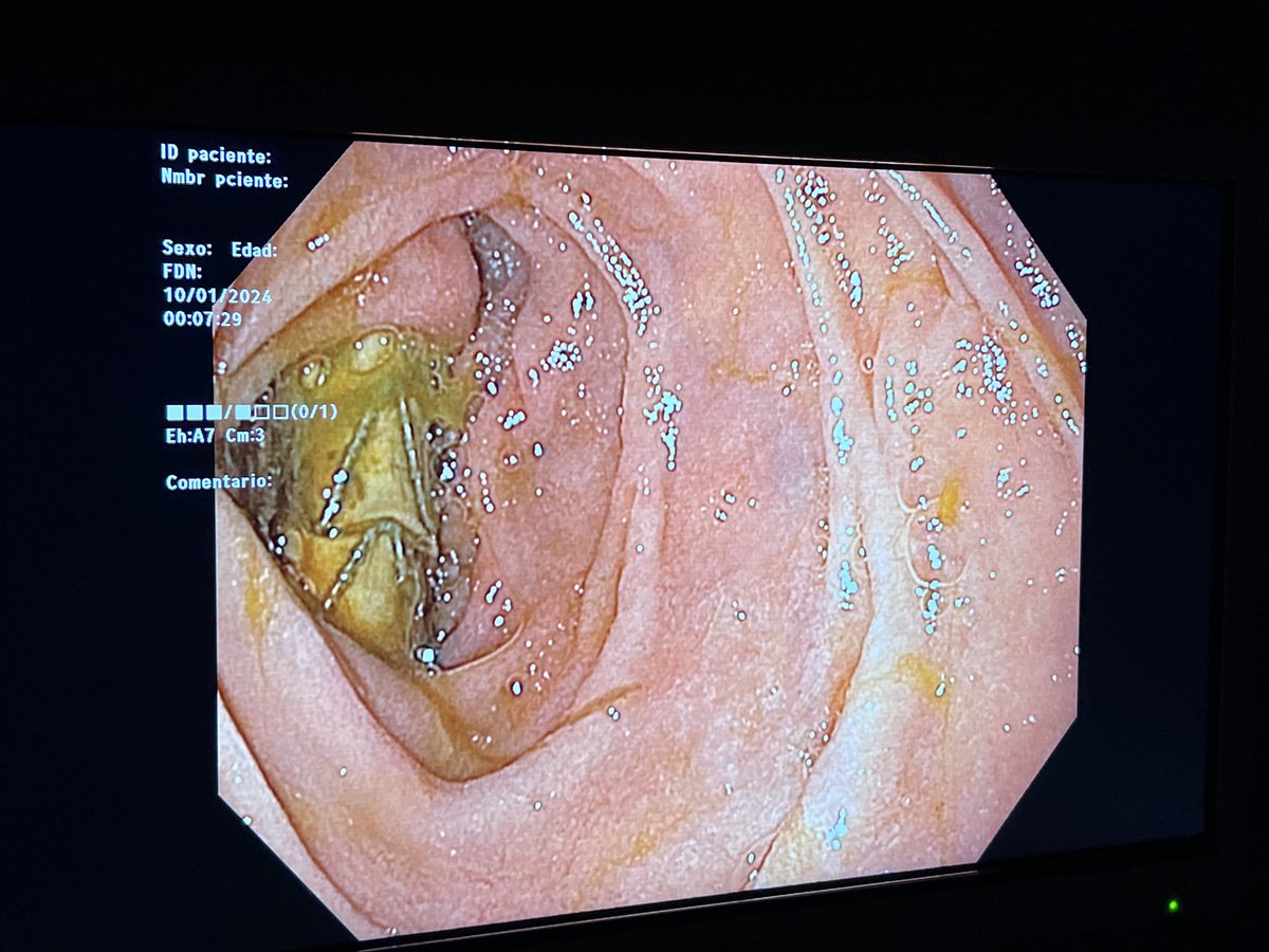 About last night… I found that image in an upper endoscopy in a patient with melenae… this is not a biliary stent… any guess <a href="/drkeithsiau/">Keith Siau</a>?