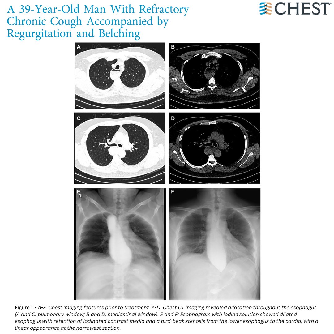 A 39-Year-Old Man With Refractory Chronic Cough Accompanied by Regurgitation and Belching What's the diagnosis? Read the #CHESTPearl in the January @journal_CHEST issue to find out: hubs.la/Q02g13_K0 #MedEd #MedTwitter