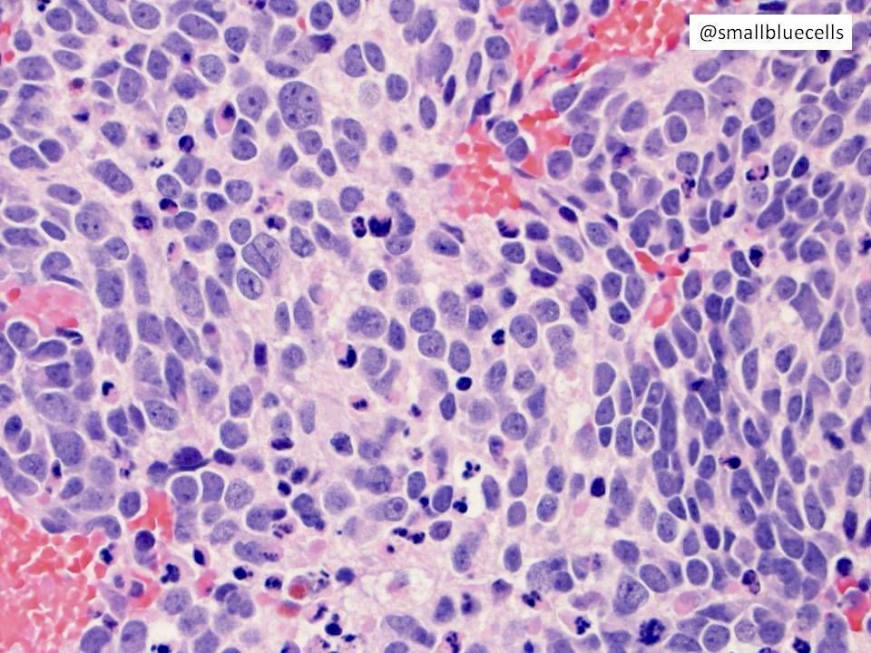 Our favorite Directory image of the week is from Jason A. Jarzembowski, M.D., Ph.D. <a href="/smallbluecells/">Jason Jarzembowski</a>
Subspecialty: Pediatric
Diagnosis: Neuroblastoma
Dr. Jarzembowski's profile: buff.ly/3vpioL0

#pathology #pathologyoutlines #profile #image #pediatric #PathTwitter