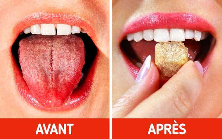 Pour liminer rapidement la douleur d'une langue brle, utilisez du  sucre  Il faut en rpandre une quantit et attendre quelques minutes pour  qu'il se dissolve sur la langue. Le sucre en poudre