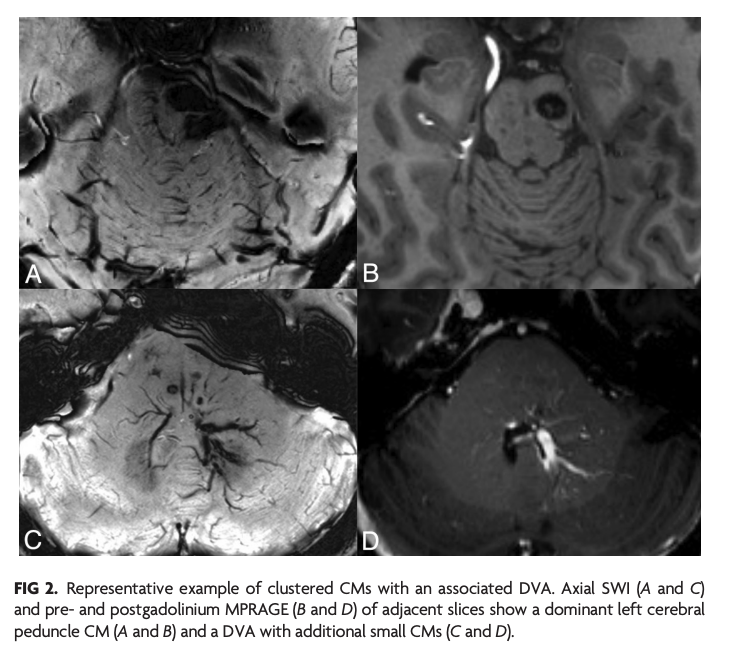 TheAJNR's tweet photo. "Prevalence of Developmental Venous Anomalies in Association with Sporadic Cavernous Malformations on 7T MRI"

https://t.co/x6NMRWXNql

#DVA #CavMal #7TMRI https://t.co/CKvIp20xDU