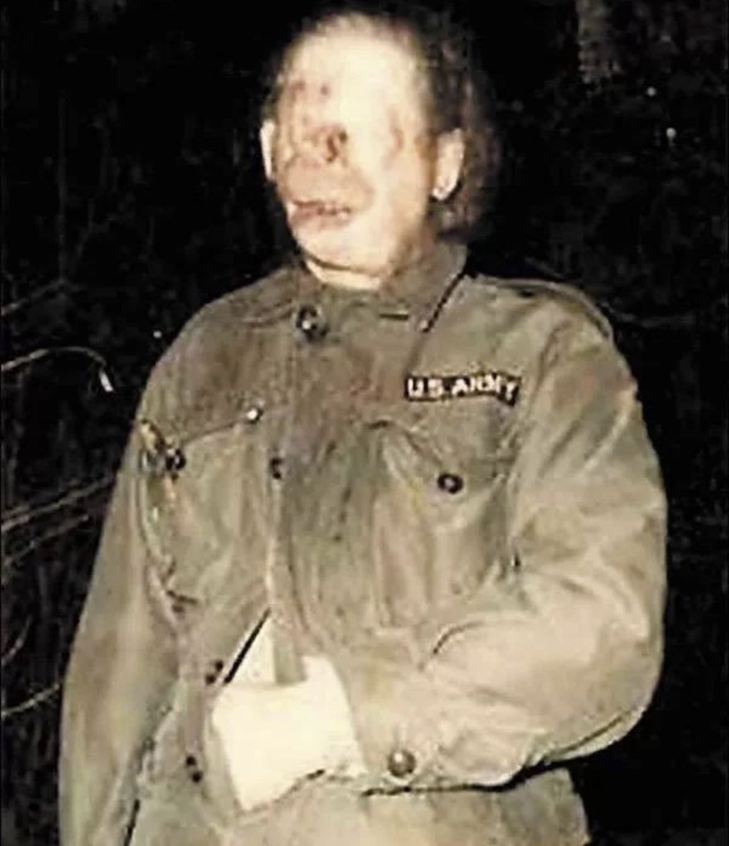 MorbidKnowledge's tweet photo. Raymond Theodore Robinson was a disfigured American man whose years of nighttime walks made him into a figure of urban legend in western Pennsylvania. 

Raymond Robinson was eight years old when he was injured by an electrical line as he climbed a pole and reached for a bird's nest on the Morado Bridge, outside of Beaver Falls. 

The bridge carried a trolley and had electrical lines of both 1,200 and 22,000 Volts, which were responsible for the death of another boy less than a year earlier. 

Robinson survived, defying doctors' expectations, but he was severely disfigured: he lost his eyes, nose, and right arm.

Robinson was so severely injured from his childhood electrical accident that he could not go out in public without fear of causing a panic, so he went for long walks at night. 

Local tourists would drive along his road in hopes of meeting the Green Man or Charlie No-Face; they became disappointed to see no such person. 

However, they passed on tales about him to their children and grandchildren regardless, and people raised on these tales are sometimes surprised to discover that he was a real person who was liked by his family and neighbors.

He stopped his walks during the last years of his life, and retired to the Beaver County Geriatric Center, where he died in 1985 at the age of 74.