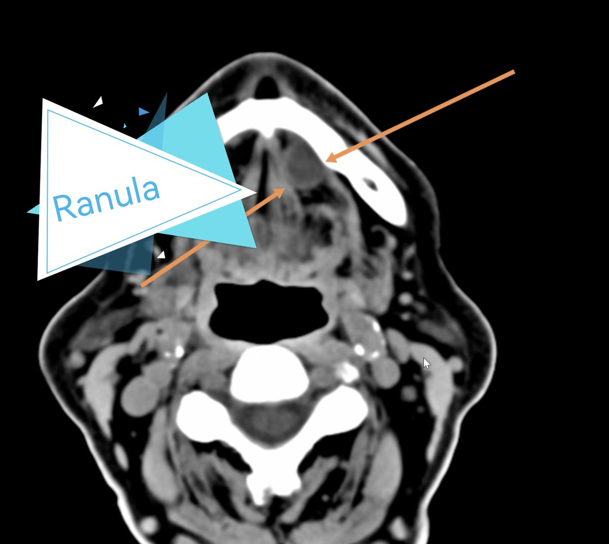 Ganymade__'s tweet photo. ✍️ The content may be increased in attenuation, even occasionally resembling a non-enhancing soft tissue mass.
✍️If a superimposed infection is present , they will be indistinguishable from an abscess, with thicker walls and surrounding fat stranding.
#residency #ct #ranula #rad https://t.co/tb3APlRrea