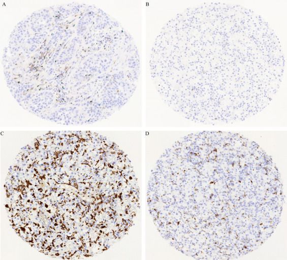 Infiltration of M2 Macrophages and Regulatory T Cells Plays a Role in Recurrence of Renal Cell Carcinoma buff.ly/3OLAJWZ @Carlsson1984 #RCC #UroSoMe #Medtwitter
