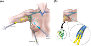 Prevención quirúrgica del linfedema del miembro superior relacionado con la cirugía axilar en el cáncer de mama. Interesante revisión sobre el tema #linfedema #cancerdemama #bcsm