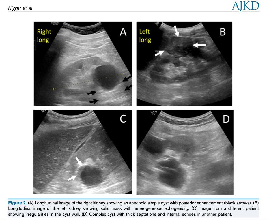 Core Curriculum by @vandyniyyar, @danielwross4, and W. Charles O’Neill: Performance and Interpretation of Sonography in the Practice of Nephrology bit.ly/4875zDD (FREE) @EmoryNephrology @HofstraKidney