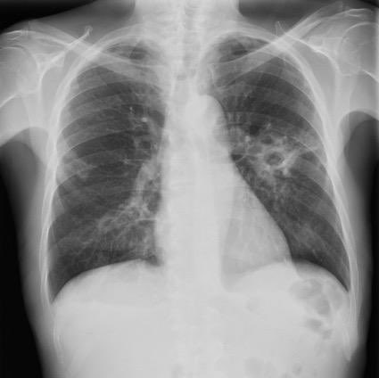 Micro_LaPaz's tweet photo. 🕵️‍♂️ #CasoClínico: 👨🏼 de 42 años procedente de Perú 🇵🇪 acude al Servicio de Urgencias 🏥 con cuadro de tos intensa y hemoptisis de varias semanas de evolución 😮‍💨 asociado a fiebre intermitente, astenia, sudoración nocturna y pérdida de peso progresiva en los últimos dos meses 🧵⤵️ https://t.co/vNJqYADvke