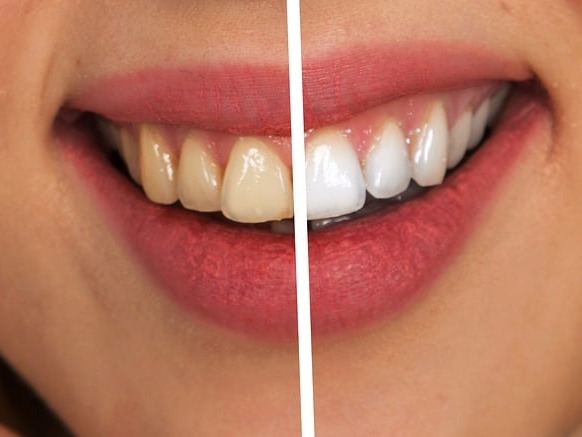 DesertSprings_'s tweet photo. Brace yourself for a beautiful smile transformation! At Desert Springs Dental Care, we offer personalized solutions to give you the perfect smile you've always dreamed of.  #lasvegasdentist #smile #SmileTransformation https://t.co/1yJZXXe2fS