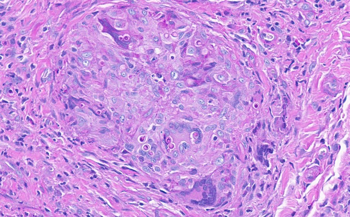 Nice picture of a granulomatous inflamatory reaction elicited by Paracoccidioides brasiliensis yeasts stained with PAS!