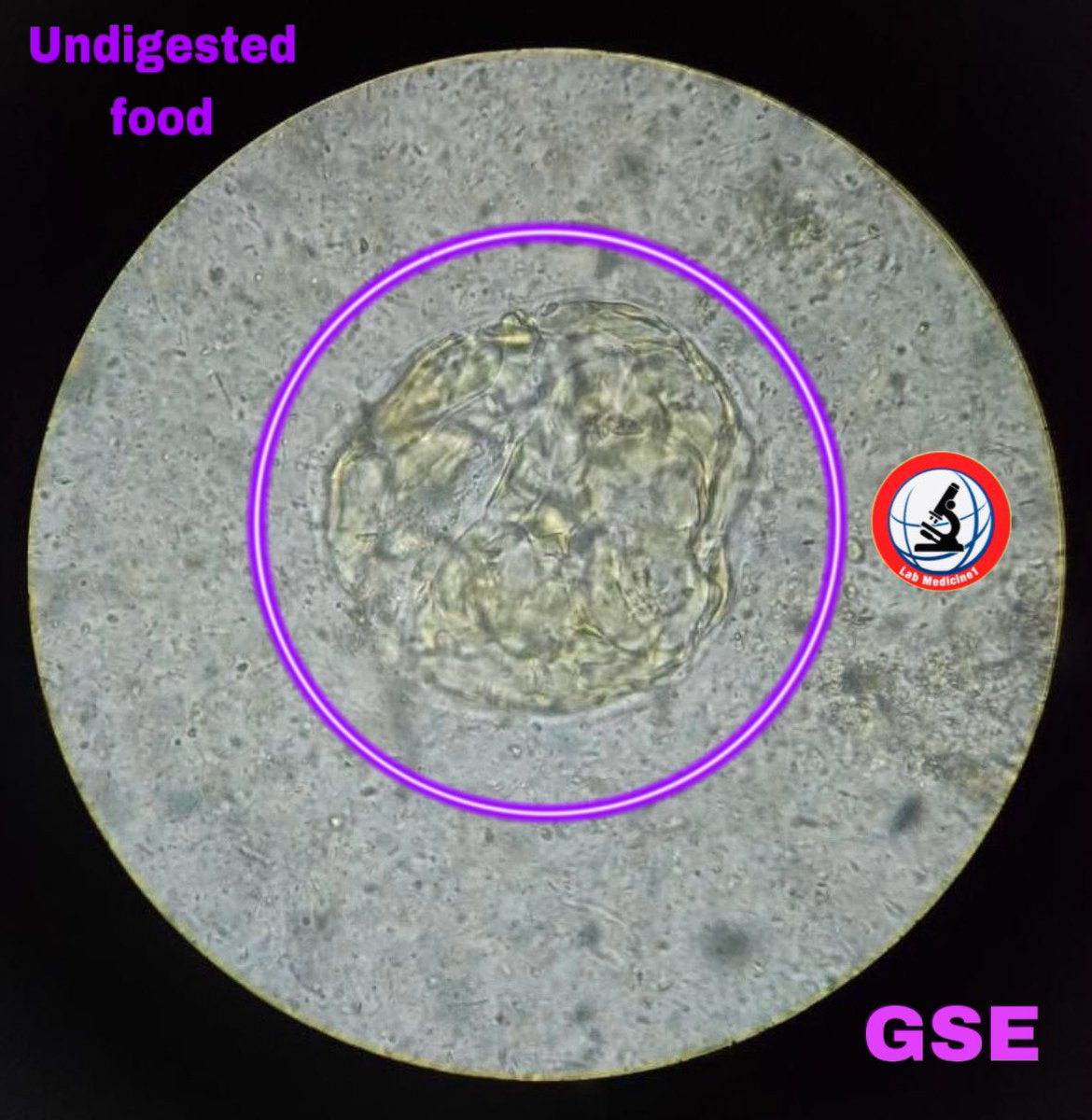 Lab_Medicine1's tweet image. #gse #GSE #undigested food youtube.com/@Lab_Medicine1