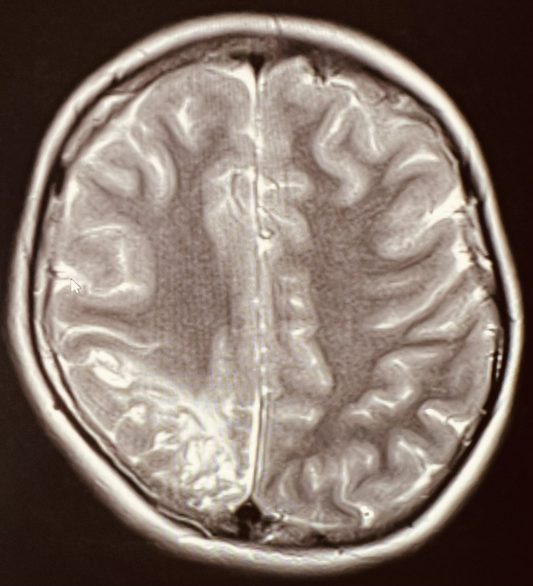 Tip of the day 💡: Hypoglycemia can be unilateral.