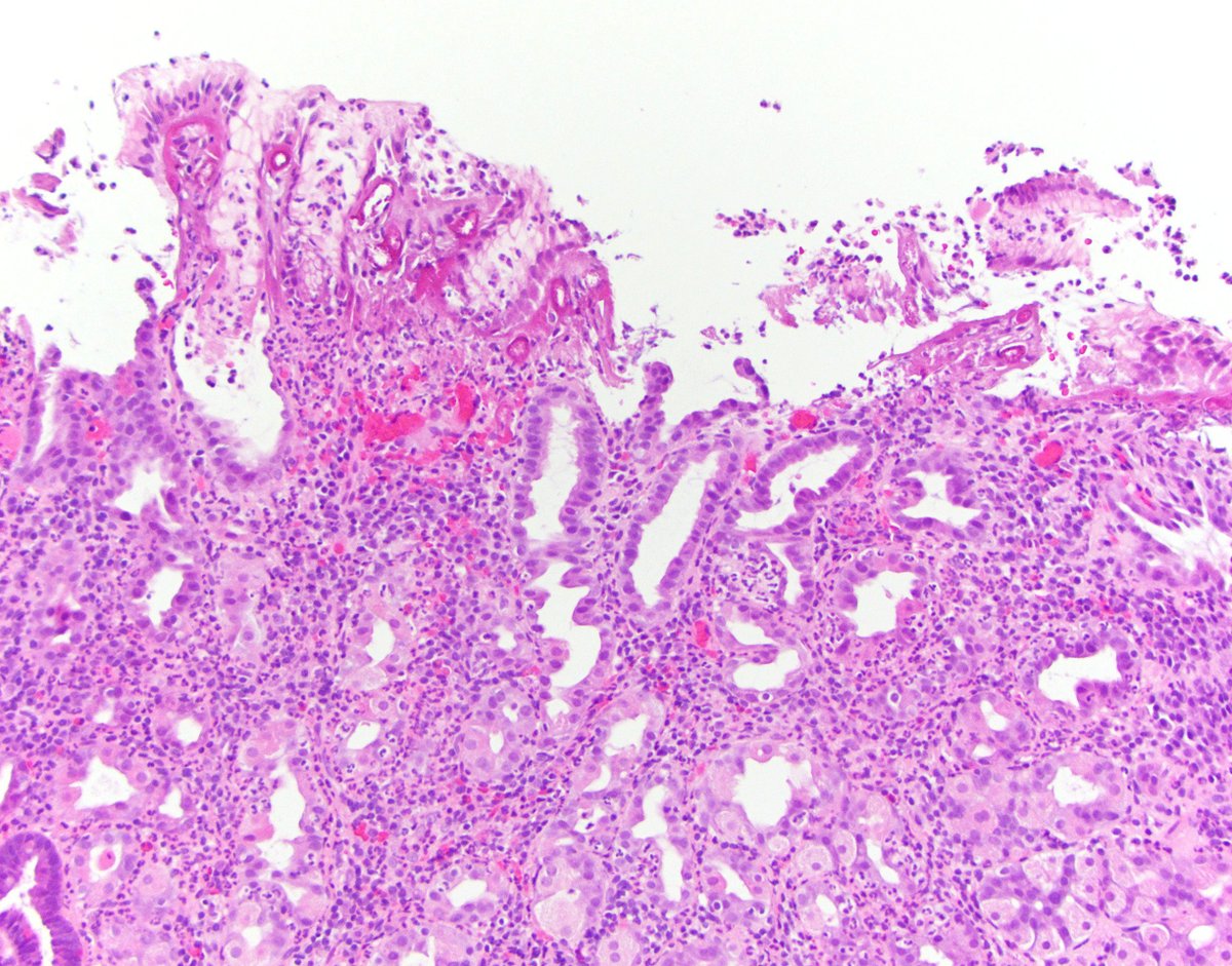 MonicaGarciaBu2's tweet photo. Exemplary case of gastric mucosal vascular injury due to doxycycline with eosinophilic necrosis of superficial capillaries... Showing up from time to time.  PMID: 28009607
@UMiamiPathology @Pathologists #pathresidents #GIpath #pathtwitter #usgips @AmCollegeGastro https://t.co/Pdq59VXlng