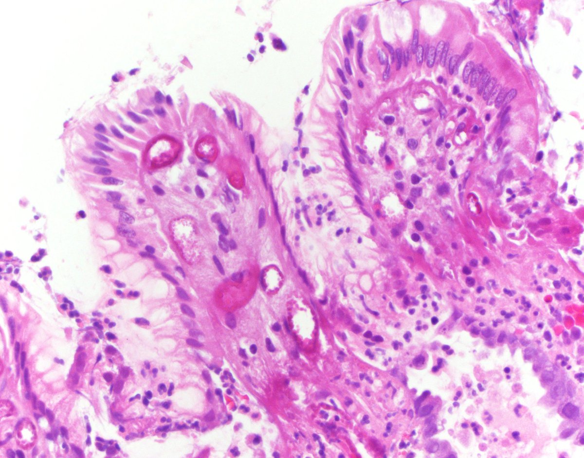 MonicaGarciaBu2's tweet photo. Exemplary case of gastric mucosal vascular injury due to doxycycline with eosinophilic necrosis of superficial capillaries... Showing up from time to time.  PMID: 28009607
@UMiamiPathology @Pathologists #pathresidents #GIpath #pathtwitter #usgips @AmCollegeGastro https://t.co/Pdq59VXlng