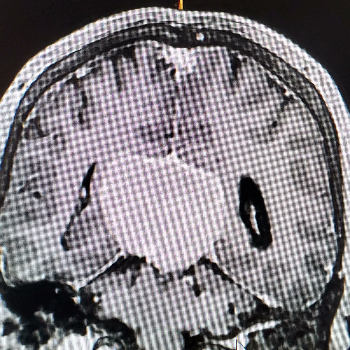 DrLeeBrainSurg's tweet photo. Renee Descartes thought that the pineal gland was the "seat of the soul".
One of the great privileges of being a #NeuroSurgeon is the ability to approach the seat of the soul to remove this #meningioma. It is truly an honor to be able to operate and serve! #litbrain @PennNSG https://t.co/UWzdbDOBOH