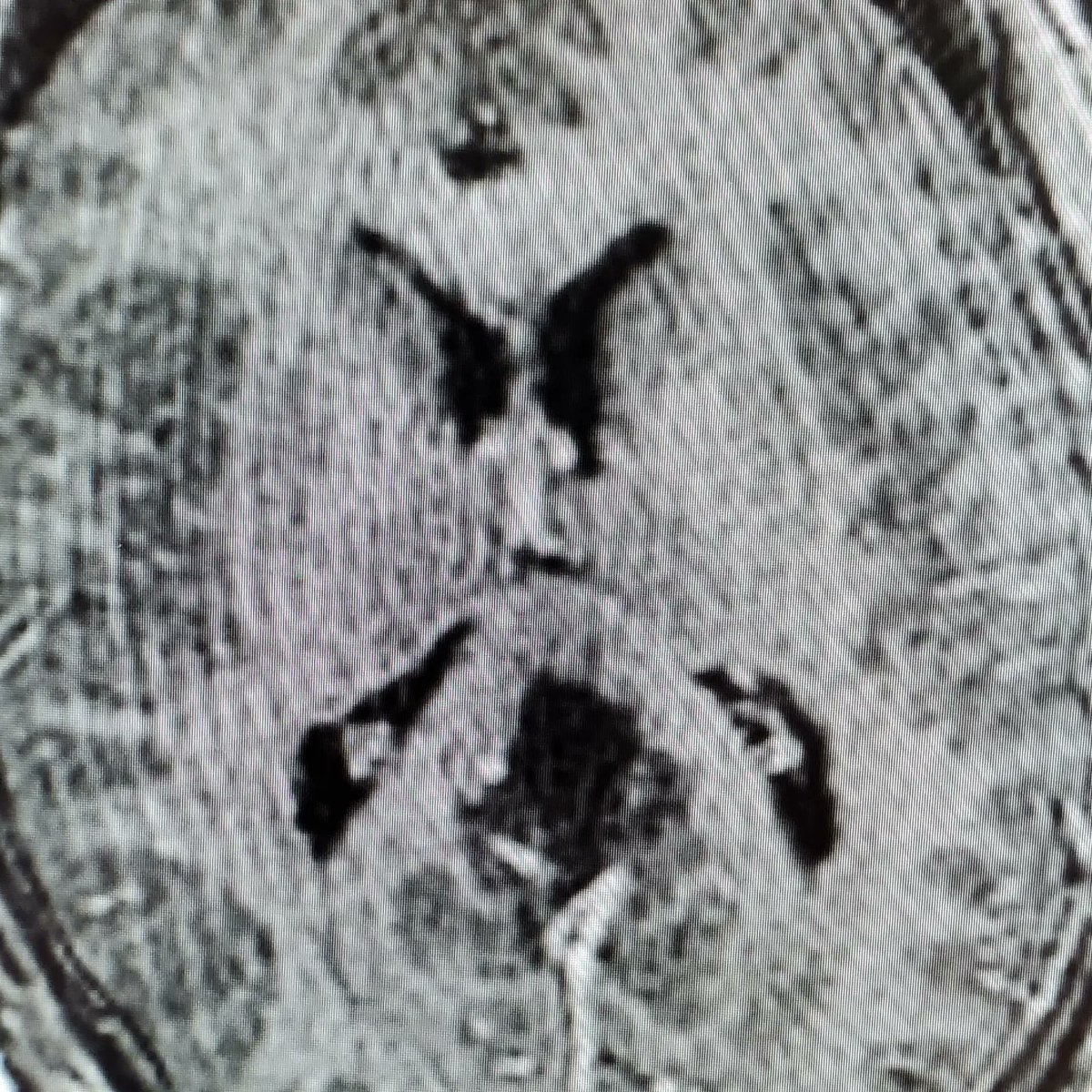DrLeeBrainSurg's tweet photo. Renee Descartes thought that the pineal gland was the "seat of the soul".
One of the great privileges of being a #NeuroSurgeon is the ability to approach the seat of the soul to remove this #meningioma. It is truly an honor to be able to operate and serve! #litbrain @PennNSG https://t.co/UWzdbDOBOH