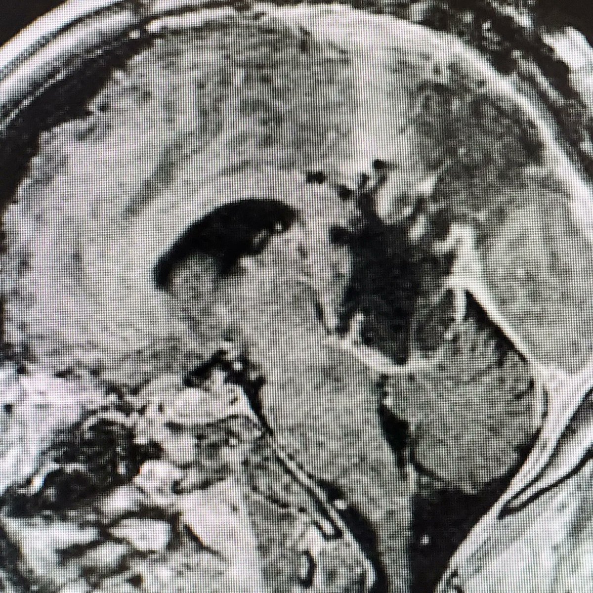 Renee Descartes thought that the pineal gland was the 'seat of the soul'. One of the great privileges of being a #NeuroSurgeon is the ability to approach the seat of the soul to remove this #meningioma. It is truly an honor to be able to operate and serve! #litbrain @PennNSG