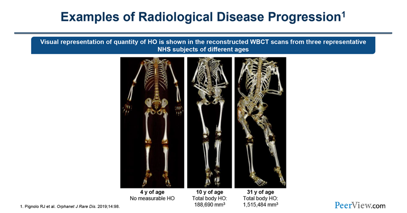 PeerView's tweet photo. Exciting News for Patients, Families and Healthcare Providers - The Full #FOP #MedEd Page Is Here! https://t.co/xqTweN5RNB @ASMBR @IFOPA #FibrodysplasiaOssificansProgressiva #IFOPA #CureFOP #BoneDisease #MedTwitter https://t.co/3a0vuDvAGg