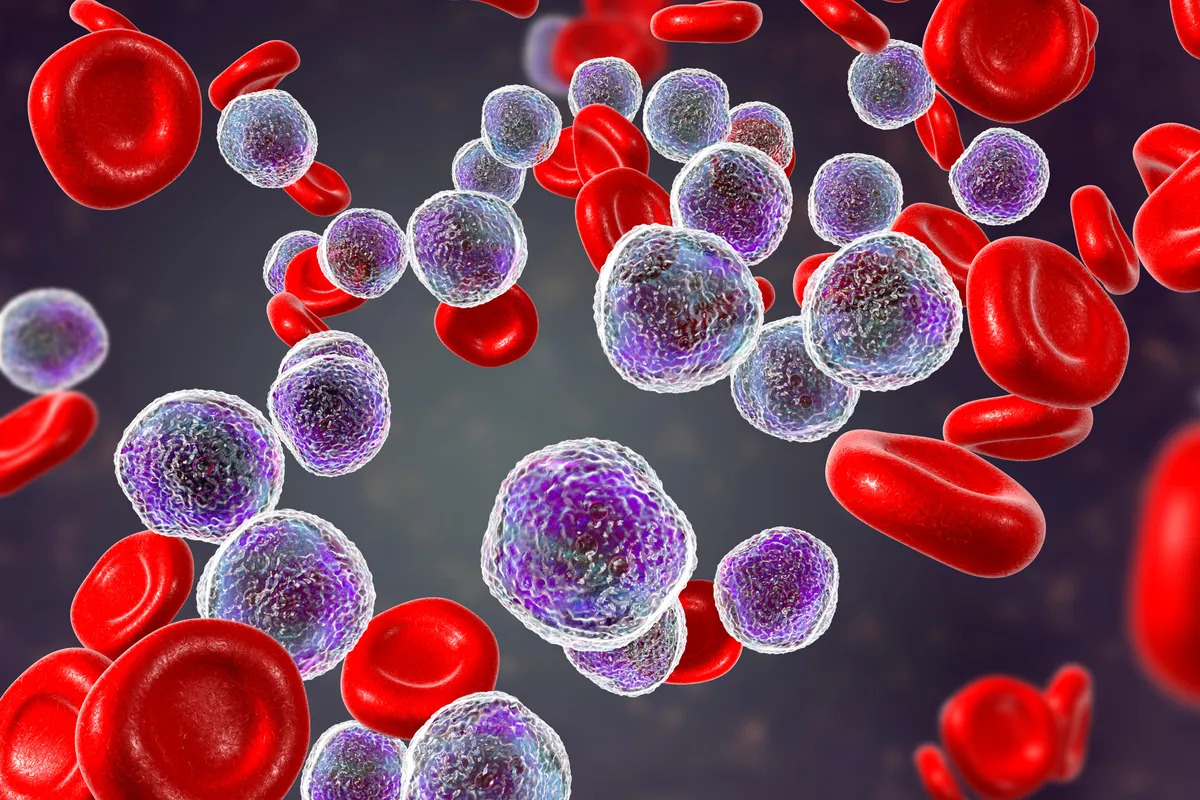 MultiplatformAI's tweet photo. Collaboration between IT specialists and medical professionals in Münster yields AI-driven leukemia diagnosis method

#AcuteMyeloidLeukemia(AML) #AI #artificialintelligence #BenjaminRisse #BloodAdvances #bonemarrowsmears #deeplearningalgorithm

https://t.co/OiZVXVuNq8 https://t.co/Gu6VVxbsea