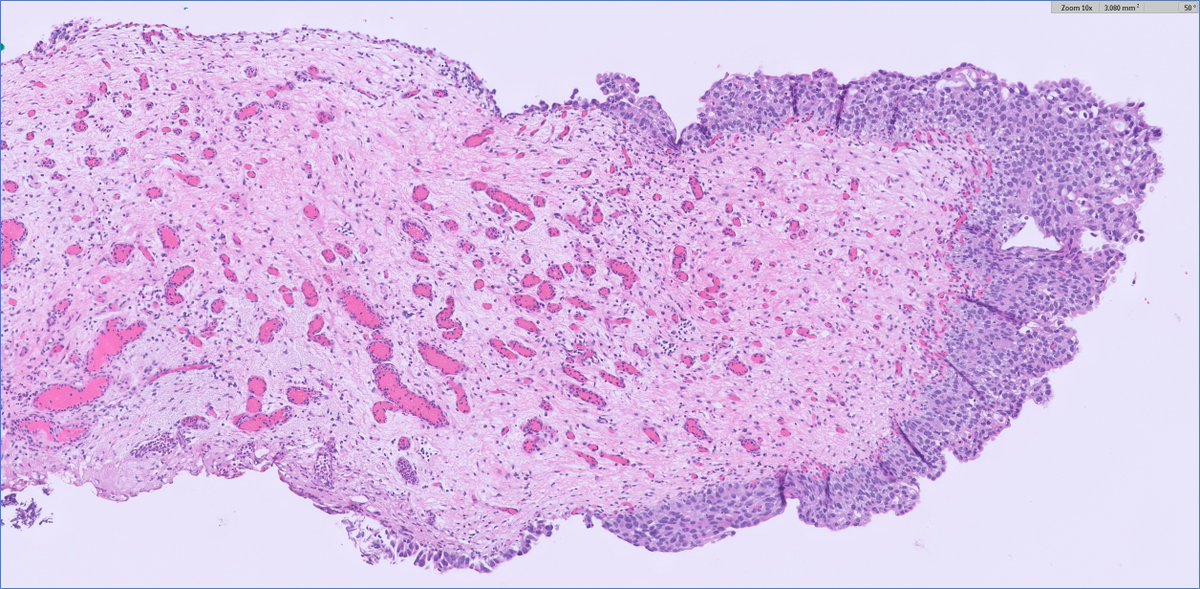 slusagar's tweet photo. #GUpath bladder bx: 

diagnostic approach?🤨next steps?
 
see more 🔬cases like this at our upcoming @TheUSCAP #InteractiveMicroscopy course in🌴😎 Palm Springs next month! 

reserve your spot now!
👉🏽https://t.co/UQiV5eygUH👈🏽 https://t.co/GqpUcT2M27