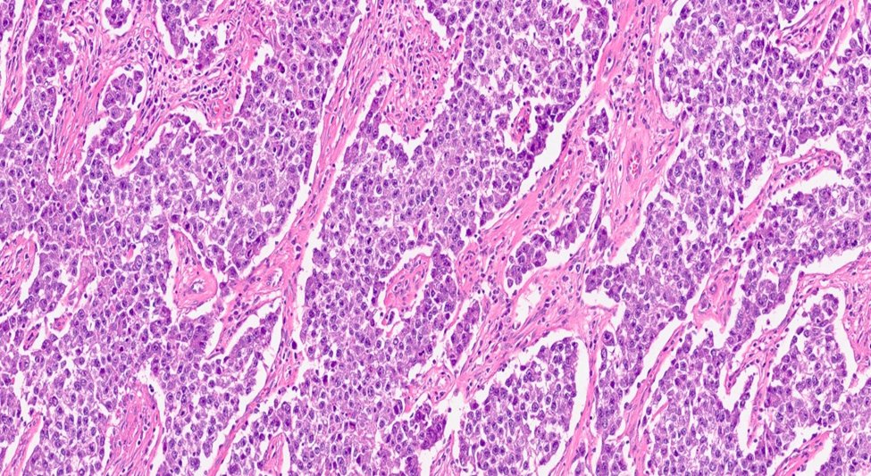 MhPathology's tweet image. 45 year old male with right testicular mass
Seminoma #PathTwitter #Medpath