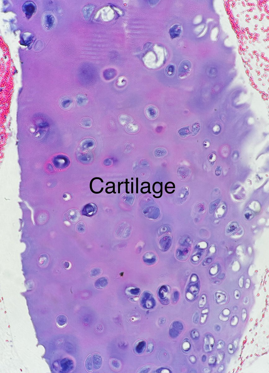 Path4People's tweet image. 🫁 Cartilage from Endobronchial Ultrasound procedure with different stains:

1) Diff-Quik (type of stain we use on Cyto)

2) Pap stain (another type of stain we use on Cyto that helps better visualize nuclear detail)

3) H&amp;amp;E correlation 

#pathagonia #cytopath #pulm #pathx #medx