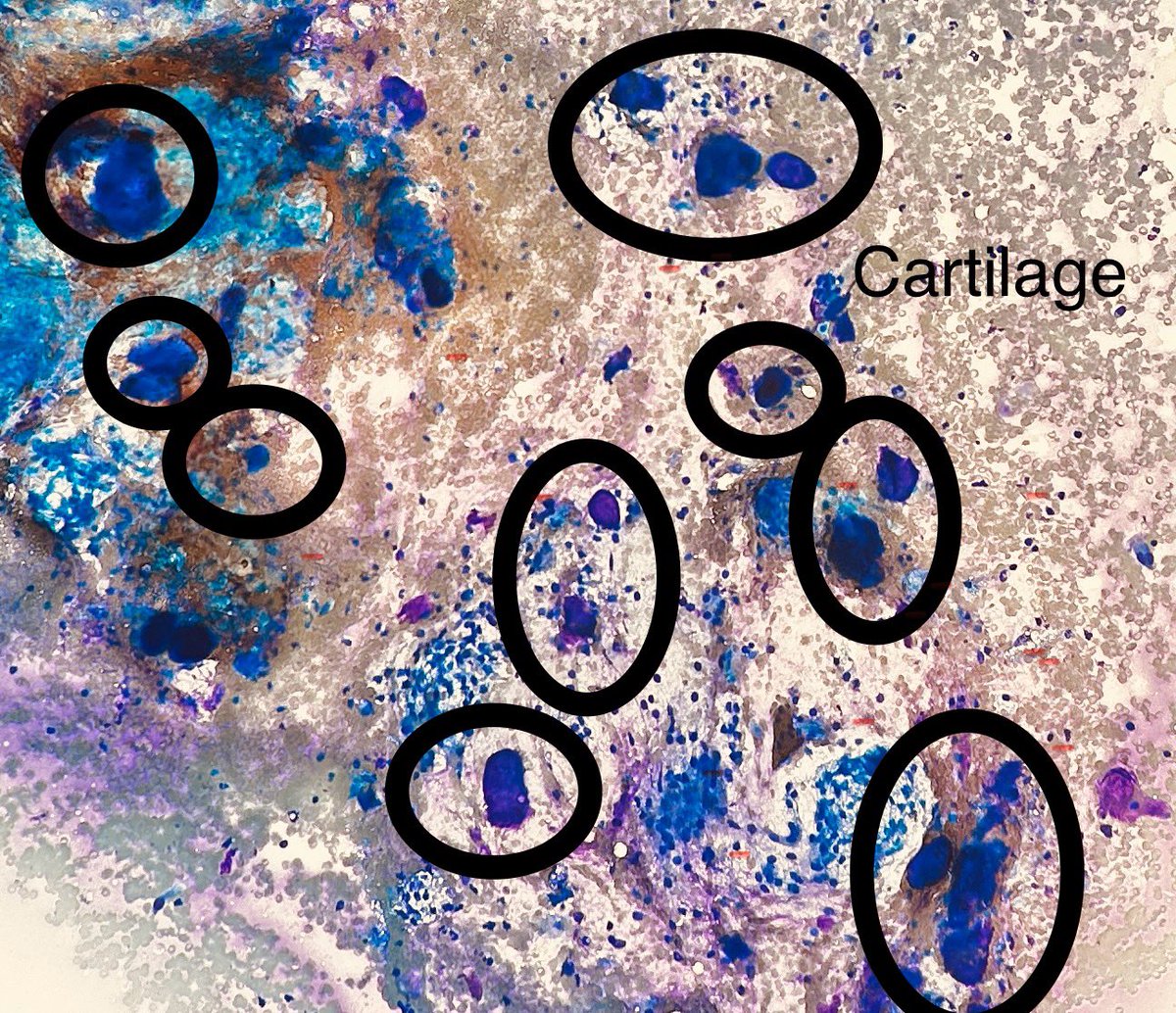 Path4People's tweet image. 🫁 Cartilage from Endobronchial Ultrasound procedure with different stains:

1) Diff-Quik (type of stain we use on Cyto)

2) Pap stain (another type of stain we use on Cyto that helps better visualize nuclear detail)

3) H&amp;amp;E correlation 

#pathagonia #cytopath #pulm #pathx #medx