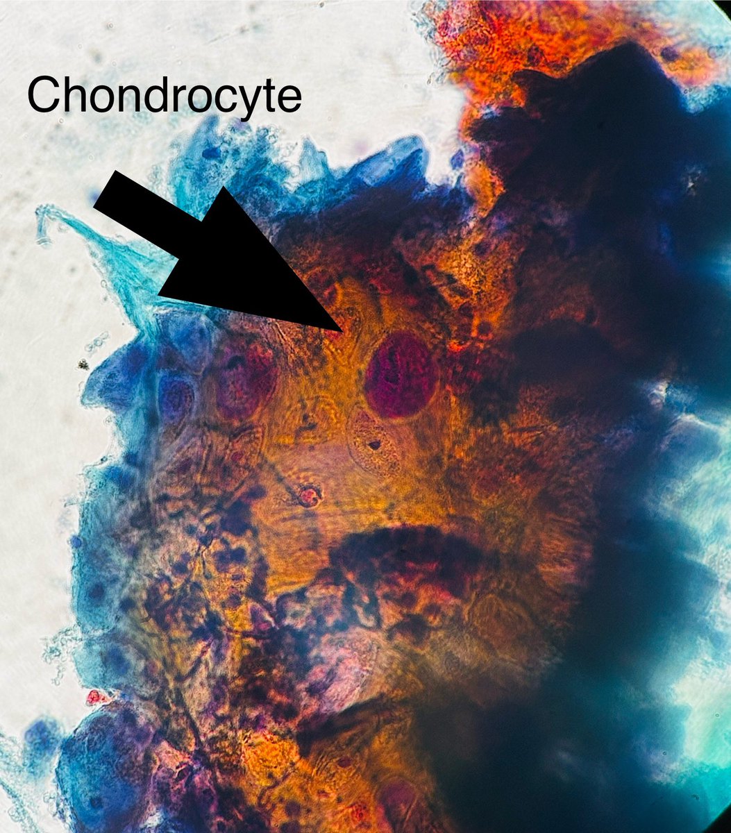 Path4People's tweet image. 🫁 Cartilage from Endobronchial Ultrasound procedure with different stains:

1) Diff-Quik (type of stain we use on Cyto)

2) Pap stain (another type of stain we use on Cyto that helps better visualize nuclear detail)

3) H&amp;amp;E correlation 

#pathagonia #cytopath #pulm #pathx #medx