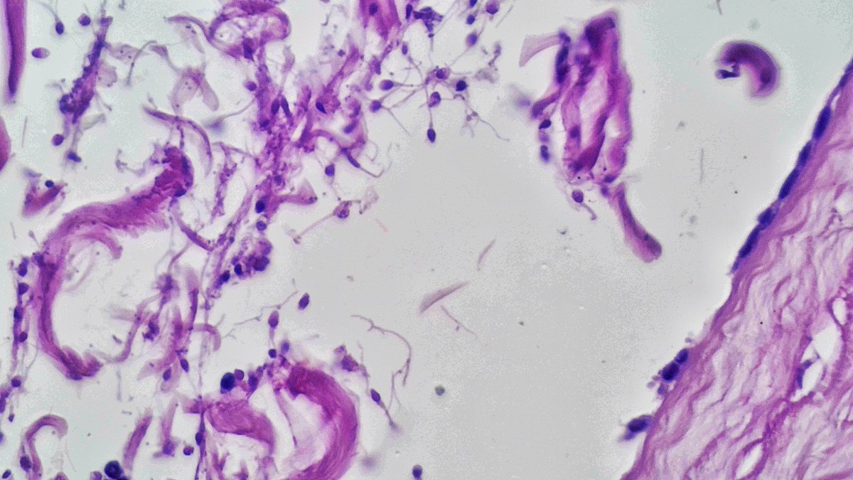 Drmerm's tweet photo. Spermatocele with an aggregate of spermatozoa
#BeautifulPath #pathtwitter #pathology #Xpath #GUpath https://t.co/wuMJqiVmjq