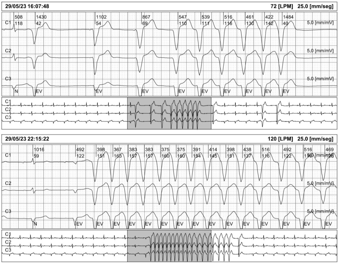 VT? @ecgrhythms @ECGfan @MosqueaRubelin @drahmedmohsen85 @HaseebEPHF @primastcar @syamkumarmd @Arritmias_HRC @SchakrabartiEP @ArritmiasNegrin @BrooksWalsh @DidlakeDW @carprimur @smithECGBlog @EF_Cardiaca @ECGcases @The_Nanashi_O @AThomazAndrade @Arron_Pearce_ @ecgandrhythmRoe