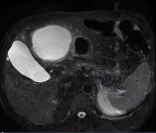 Naina Verma, MD (@nowtalk_ir_dr) on Twitter photo Thank you to <a href="/anjohri/">Ansh Johri, MD, MS</a> for his talk on the novel procedure of Hepatic Hilar Nerve block for analgesia during alcohol sclerotherapy of a recurrent large liver cyst. 👏
#InterventionalRadiology <a href="/SatyaMorar/">Satya K. Morar, MHM</a> <a href="/VirShadowing/">VIR Shadowing</a> Thank you to <a href="/anjohri/">Ansh Johri, MD, MS</a> for his talk on the novel procedure of Hepatic Hilar Nerve block for analgesia during alcohol sclerotherapy of a recurrent large liver cyst. 👏
#InterventionalRadiology <a href="/SatyaMorar/">Satya K. Morar, MHM</a> <a href="/VirShadowing/">VIR Shadowing</a>
