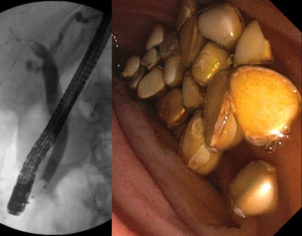 Vishnu Kumar (@dr_vishnukumar) on Twitter photo A stone fest extravaganza: Numerous stones removed, duct swept clean completely. Did not give my attending <a href="/theganesh/">Ganesh chouhan</a> a reason to touch the scope today ๐<a href="/UpstateGastro/">Upstate Gastroenterology</a> <a href="/MuzaffarAkbar/">Hafiz Muzaffar Akbar Khan</a> <a href="/BishnuS56122741/">Bishnu Sapkota</a> <a href="/KelitaSingh/">Kelita Singh</a> #GITwitter A stone fest extravaganza: Numerous stones removed, duct swept clean completely. Did not give my attending <a href="/theganesh/">Ganesh chouhan</a> a reason to touch the scope today ๐<a href="/UpstateGastro/">Upstate Gastroenterology</a> <a href="/MuzaffarAkbar/">Hafiz Muzaffar Akbar Khan</a> <a href="/BishnuS56122741/">Bishnu Sapkota</a> <a href="/KelitaSingh/">Kelita Singh</a> #GITwitter