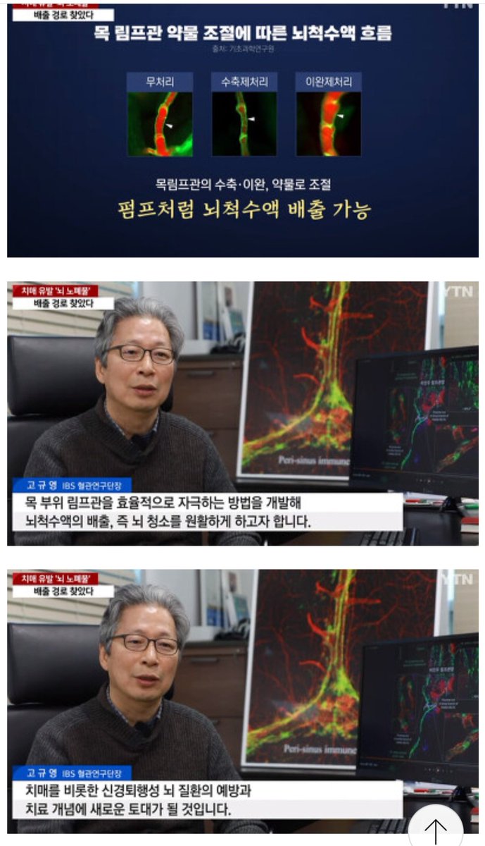 치매 연구 근황 (뇌 노폐물 배출경로 찾음)

1. 사람이 머리를 쓰면 뇌에서 노폐물이 만들어지고, 이 노폐물이 뇌 밖으로 배출되지 않고 쌓이면
신경세포를 손상하여 치매와 같은 뇌 질환을 일으키는데 지금껏 이 노폐물을 포함한 뇌척수액이
어디로 어떻게 빠져나가는지에 대한 주요 경로를 발견하지