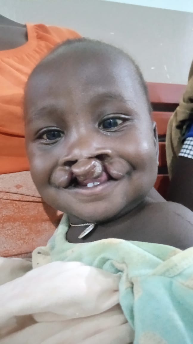 #2024smiles.

#PlasticSurgeons in Uganda work tirelessly to transform the smiles of children with #Cleftlip and #Palate. 

We pride in transforming lives with early intervention! #plasticsurgery #PatientSafety #PatientCare #Cleft #Health #Surgery