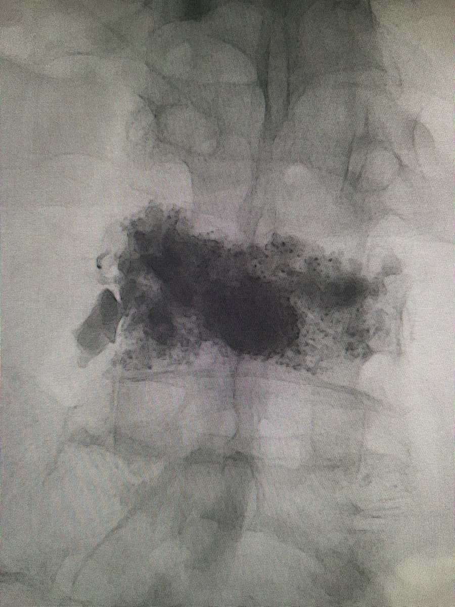 darthglader's tweet image. Excellent fill of the vertebral body with #KyphonVue! Only one way to truly celebrate such a good fill: 

#AirGuitar

Thanks to @Coachkevin1026 for being the #BackupSinger