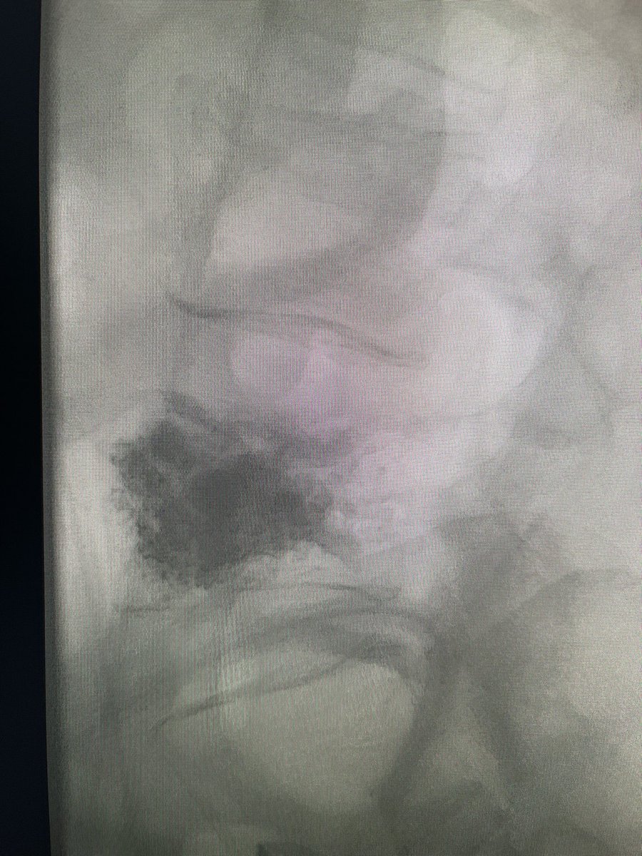 darthglader's tweet image. Excellent fill of the vertebral body with #KyphonVue! Only one way to truly celebrate such a good fill: 

#AirGuitar

Thanks to @Coachkevin1026 for being the #BackupSinger