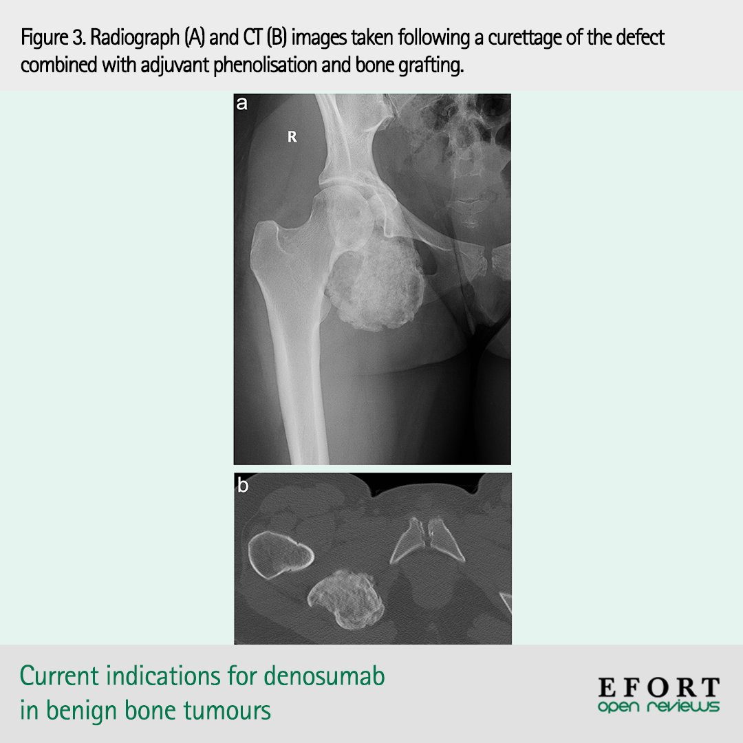 EFORTnet's tweet photo. Promising results reported regarding off-label use of #denosumab in giant cell-rich tumours/tumour-like lesions, i.e. aneurysmal #bonecysts & central giant cell #granulomas. Large prospective clinical trials are needed !
π https://t.co/GRTgI6Xu61 #GCTB #Oncology #OpenReviews https://t.co/IjsqZOqTb5