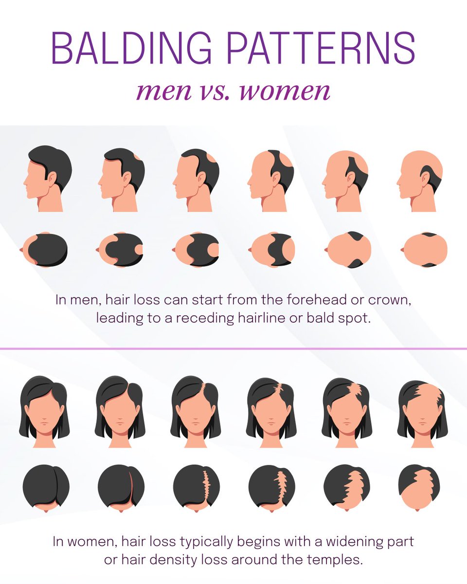 ABFCSorg's tweet photo. Male &amp; female pattern baldness, both known as androgenetic alopecia, differ mainly in the location of #HairLoss.

If you're struggling with hair loss, contact a qualified board-certified facial cosmetic surgeon to discuss hair restoration options. https://t.co/2Frziot0De