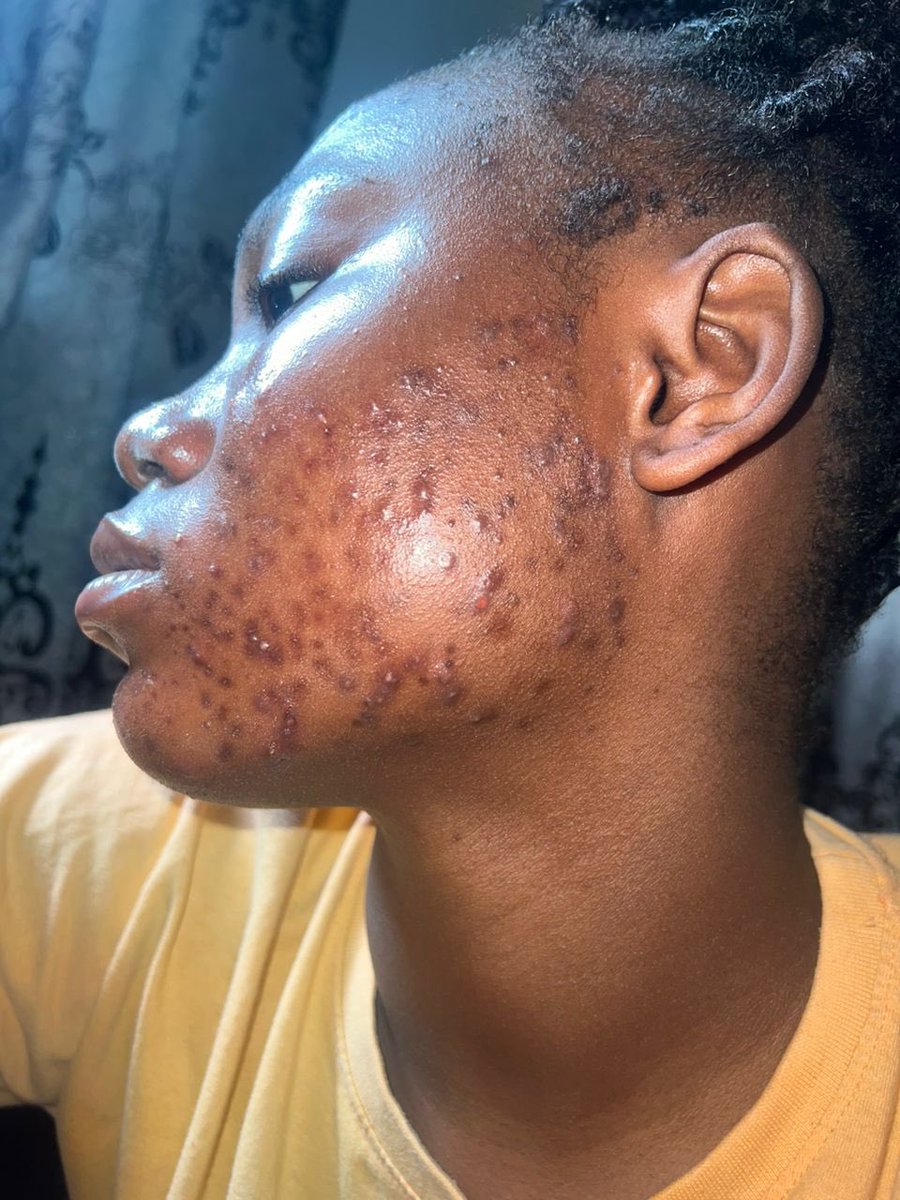 skinindulgence1's tweet photo. How it started VS How it’s going.
Acne can be managed with the right products and routine,send a dm today .
Your skin is safe with us 🫂 https://t.co/1fjW3e1GsW