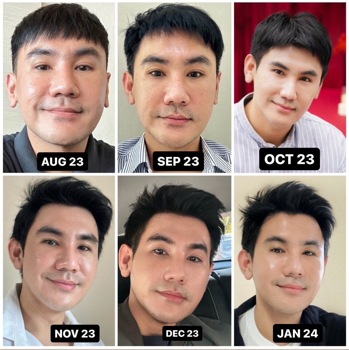 ได้ฤกษ์มาเล่าเรื่อง Sculptra  ให้ฟัง. หลังจากฉีดขวดแรกกับทาง <a href="/DSKclinic/">DSK Clinic คลินิกเลเซอร์ หลุมสิว ปรับรูปหน้า</a> ครบ 6 เดือน บอกเลยว่าสมคำร่ำลือเรื่องการกระตุ้นคอลลาเจน ย้อนวัย โกงอายุให้ผิว.