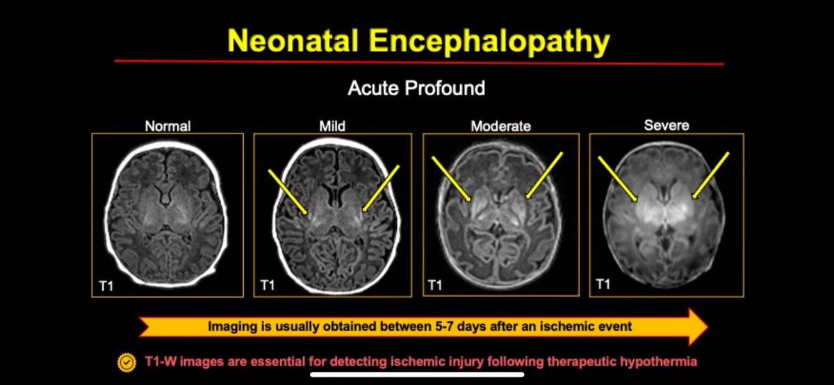 First up in #corecurriculum at #ASPNR24 is Dr Sumit Pruthi @sumsnet, teaching us about hypoxic ischemic encephalopathy!#pedineurorad @VUMCradiology