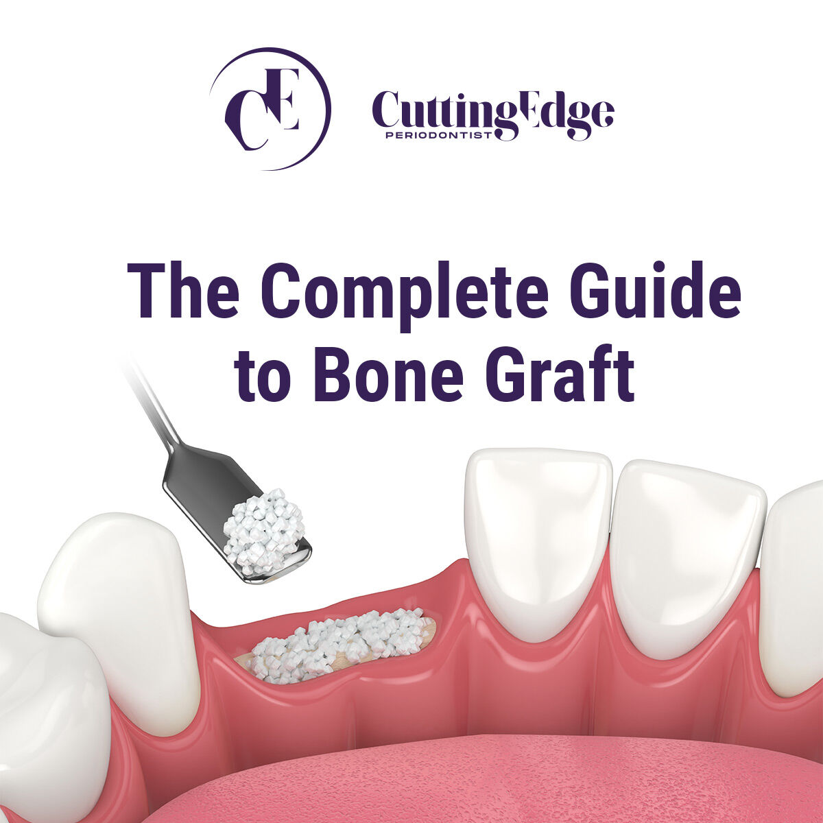 The Complete Guide to Bone Graft - bit.ly/3xy9bOF  #bonegraft #dentalbonegraft #bonegrafting #periodontist #DrDianaSedler #CuttingEdgePeriodontist #Burbank #Glendale
