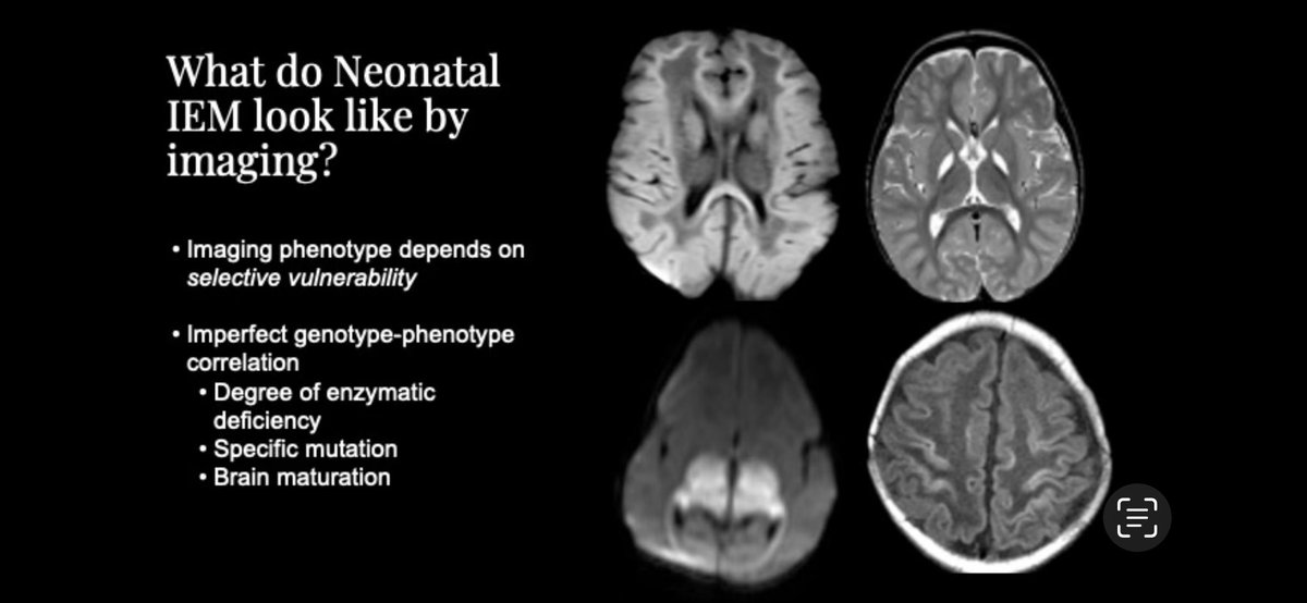 Dr Yi Li @YiLiMD from @UCSFimaging teaching about Acute Neonatal Metabolic Syndromes now in #corecurriculum at #ASPNR24 #pedineurorad