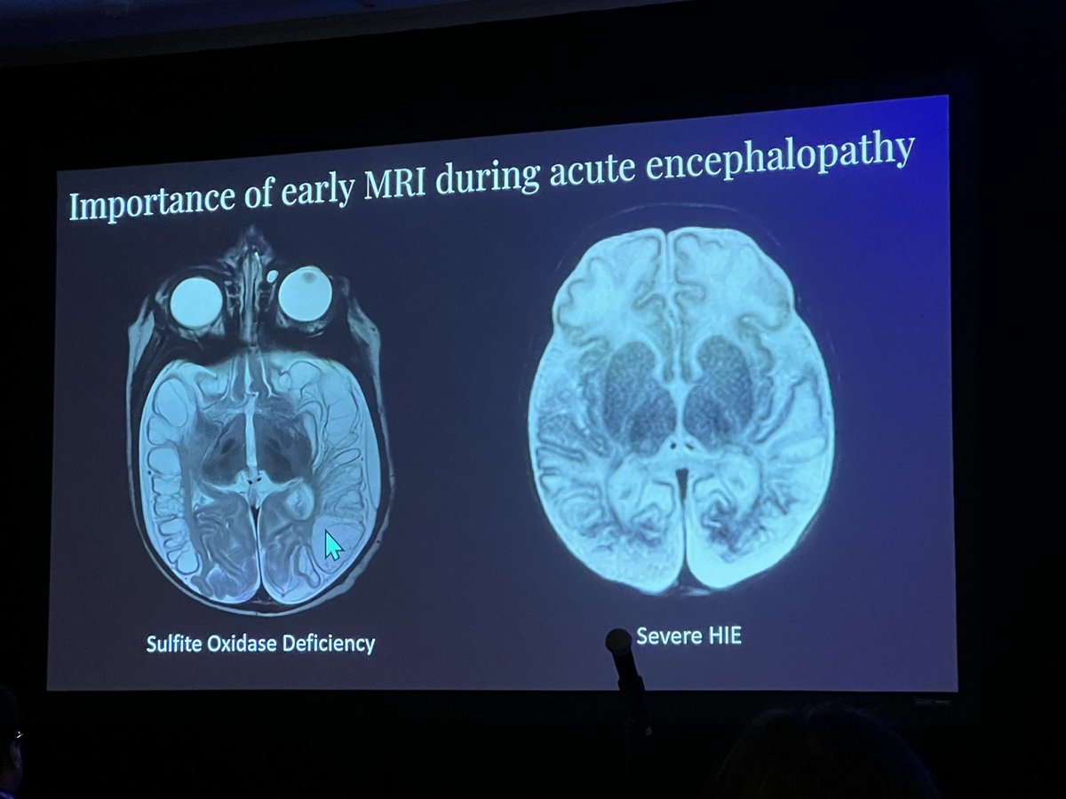 @YiLiMD shows us the importance of clinical history in diagnosis of in born errors of metabolism. Atypical clinical presentation for HII and sparing of the thalami raises suspicion. #ASPNR2024 #pedineurorad #radres